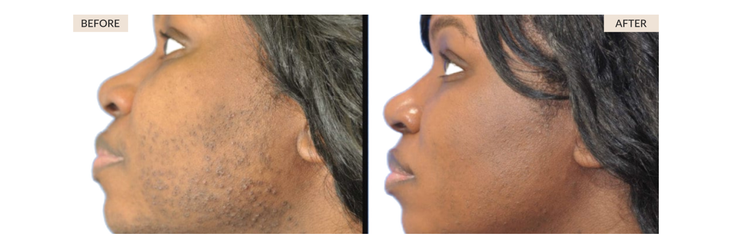 The Best Laser Treatments For Darker Skin Tones | The AEDITION
